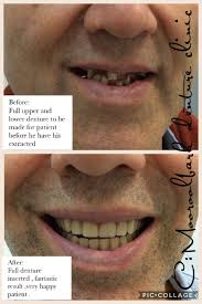 It is a transitional denture therefore. Immediate Dentures Denture Clinic Melbourne