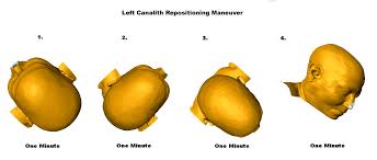 Image result for Canalith Repositioning Procedure