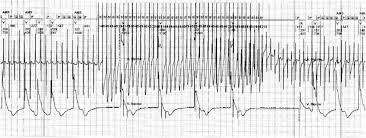 Furthermore, overdrive suppression of repetitive purkinje fibre activity is a well known electrophysiological phenomenon. Overdrive Pacing Modifying Atrial Tachycardia Into Atrial Fibrillation Download Scientific Diagram