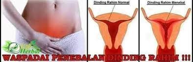 Perdarahan abnormal memang bisa jadi salah satu gejala dari penebalan dinding rahim. Gejala Penebalan Dinding Rahim Atau Terapi Cepat Hamil Facebook