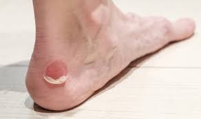 Ampollas Y Rozaduras En Los Pies Como Se Pueden Curar Y Prevenir Podoactiva Lideres En Podologia