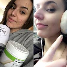 Here we have putforth few causes, types and remedies to get rid of dark spots. After 7 Days Of Herbalife Skin I M Reviving Herbalife Herbalife Results Herbalife Diet