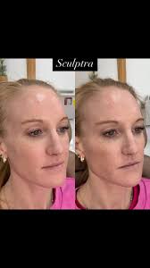 I absolutely love a Sculptra immediately before and after., So full and  plump from the water yet the Sculptra hasn’t even begun to do its  thang…just wait! , ⬇️ To Book⬇️, 💗Injector Artist Aesthetic💗, ...