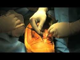 Total Knee Replacement Surgery 2011 Hd Youtube Total Knee Replacement Knee Replacement Knee Replacement Surgery Video