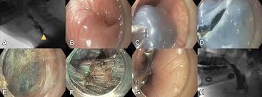 We did not find results for: No Pouch No Problem Successful Endoscopic Division Of A Symptomatic Cricopharyngeal Bar Using A Modified Peroral Endoscopic Myotomy Technique For Zenker S Diverticulum Videogie