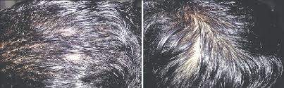 The color of your hair can be a link to your personality and a way to express your individuality. A And B Well Demarcated Areas Of Hair Loss On The Scalp With Normal Download Scientific Diagram