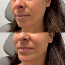 ✨ Facial Balancing with Filler: What You Need to Know ✨ Facial balancing is  all about enhancing your natural features to create a more harmonious look.  With dermal fillers, we can subtly