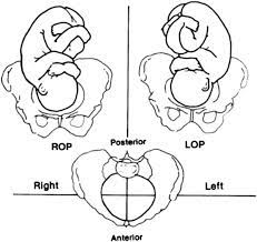 Fetal Occipito Posterior Op Position There Are Three Op Positions Download Scientific Diagram