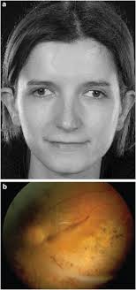 Clinical features of the congenital vitreoretinopathies