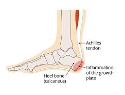 Image result for Calcaneal Apophysitis