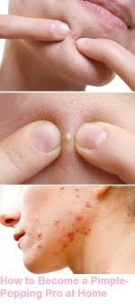 What To Do After You Popped A Pimple Skin Care Pimple Popping Skin Care Pimples Pimples Under The Skin