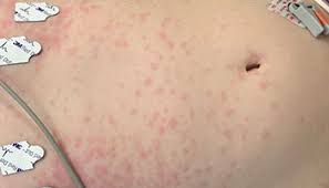 Find & download the most popular crash photos on freepik free for commercial use high quality images over 10 million.crash photos. Snapshot Science Could Photos Of Rashes Help Clinicians Diagnose Mis C Chop Research Institute
