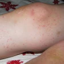 Skin Rash Causes 68 Pictures Of Symptoms And Treatments