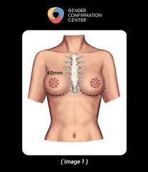 Our healthcare credit card can be used to pay for a variety of cosmetic and dermatology procedures such as breast augmentation and laser hair removal. Non Binary Top Surgery Gender Confirmation