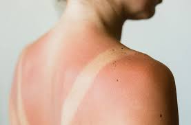 Of course, that doesn't apply if you have fair skin. the fair skinned among us never get a tan, so they always get sunburned. How To Treat A Sunburn And Prevent It Next Time Health Essentials From Cleveland Clinic