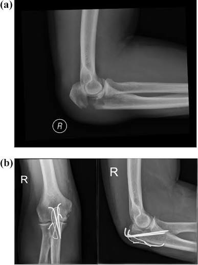 Olecranon (Elbow Tip) Fracture Treatment: Tension Band Wiring & Plating in Jamshedpur | Dr. Pritpal Singh Saini