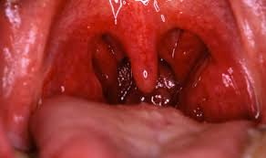 This might lead to them being found at a very early stage. Cancer Symptoms Sore Throat Is A Sign Of This Uncommon Disease Express Co Uk