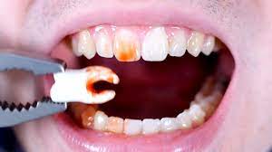 Watch this video and you will learn how this procedure is done. Tooth Pulled At Home Youtube