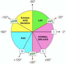 Right Axis Deviation (RAD) • LITFL • ECG Library Diagnosis