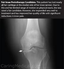 Prolotherapy Knee Osteoarthritis Research An Option To Knee Surgery Caring Medical Florida