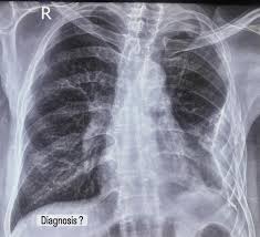 Image result for Pleural Tuberculosis
