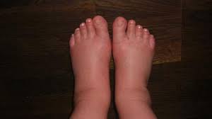 Soviel Wasser In Den Beinen Und Fussen Das Ist Kaum Laufen Kann Forum Fur Juni 2011 Mamis