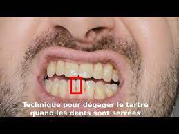 Whisk continuously while streaming in the. Comment Enlever Le Tartre Entre Vos Dents Trop Rapprochees Pour Les Brossettes Interdentaires Youtube