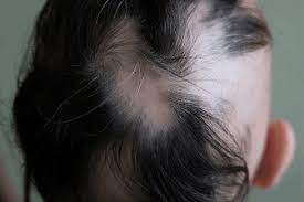 Alopecia areata can also reoccur after alopecia regrowth. 3 Signs Of Regrowth In Alopecia Areata Lady Alopecia
