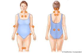 Fibromyalgia Tender Points And Trigger Points Fibromyalgia