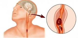 Beyin Sapi Damar Tikanikligi Belirtileri Ve Tedavisi Beyin Gen Tr