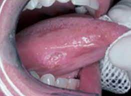 What does early signs of tongue cancer look like? Oral Cancer Images The Oral Cancer Foundation
