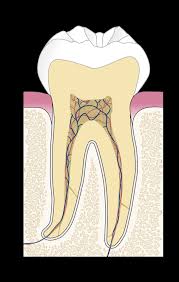 Möchten sie den zahn erhalten und die entzündung therapieren, muss die zahnwurzel behandelt werden: Wurzelbehandlung Zahne Vor Dem Verlust Retten