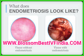 Endometriosis Archives Blossom Ivf Indiablossom Ivf India
