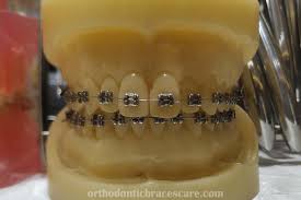 We did not find results for: Why Are My Teeth Turning Yellow With Braces Orthodontic Braces Care