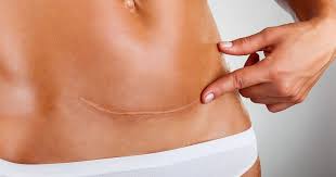 Cat ne costa o operatie de apendicita in principalele spitale private din romania? Semiconductor NepoatÄ A Accelera Cat Costa O Operatie De Apendicita Cu Laser Lmvdesigns Com