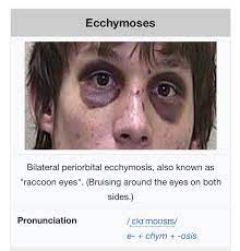 Check spelling or type a new query. One Of The Symptoms Of Bubonic Plague Look Familiar Ghostbc