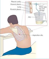 Potential nursing diagnosis for ventilatory assistance (mechanical). Assessment And Management Of Patients With Pleural Effusions