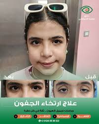 ▫️ Droopy Eyelid Correction. ▫️ In children, a droopy eyelid can affect not  only vision, but also the child's confidence and emotional well-being. ▫️  Early management is important to support healthy visual