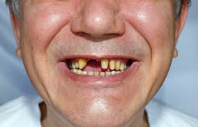 We did not find results for: Dangers Of Ignoring A Tooth Abscess Guelph Dentist