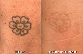 Trifecta med spa is currently offering completely free evaluation and consultation services in downtown manhattan nyc for any of the conditions which. Laser Tattoo Removal Nyc Manhattan Queens Glamoi Med Spa
