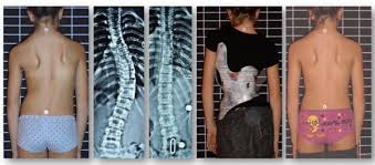 Cast based Chêneau brace with nearly full correction of a double major... |  Download Scientific Diagram