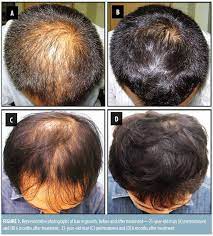 In the late stages, the hair follicles are dead and at. Androgenetic Alopecia Treatment In Asian Men Jcad The Journal Of Clinical And Aesthetic Dermatology