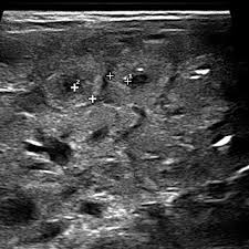 Results a total of 26,087 antifungal eye drop units were sold, with a mean of 2.3 per patient. Pdf Diagnostic Imaging Features Of Necrotizing Enterocolitis A Narrative Review