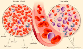 Image result for Acute Leukemia