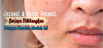 Anda mengalami masalah gegata ? Hilangkan Parut Jerawat Dalam Masa 3 Hari Ohcantik Com