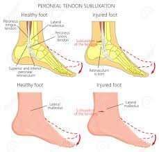 The main symptoms of inferior extensor retinaculum pain are: Vector Illustration Of Peroneal Tendon Injuries Peroneal Tendon Royalty Free Cliparts Vectors And Stock Illustration Image 91011206