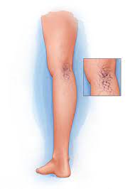 Varicose Vein Treatment Sclerotherapy Ivc Interventional Vascular And Vein Center