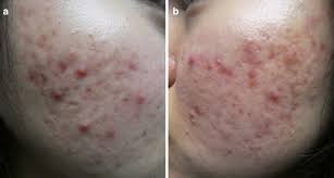 Inflammatory breast cancer doesn't commonly form a lump, as occurs with other forms of breast cancer. Acne Vulgaris A Patient And Physician S Experience Springerlink