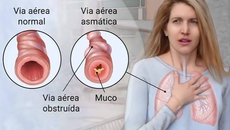 Asma: Causas, Prevenção, Sintomas, Tratamentos e Mais | Saúde – Blog OPAS
