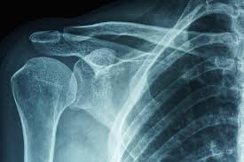 Image result for Frozen Shoulder